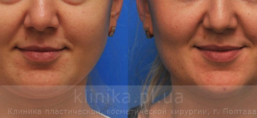 Фото до та після видалення комків Біша: результати та враження