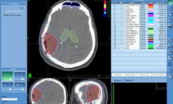 Гліобластома: Чи Існують Реальні Шанси на Одужання? Інформація та Досвід