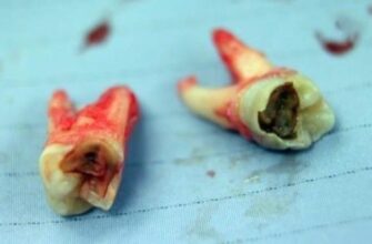 Гнилі зуби уві сні: значення, тлумачення та приховані смисли сновидінь