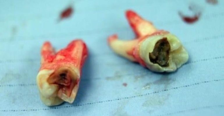 Гнилі зуби уві сні: значення, тлумачення та приховані смисли сновидінь