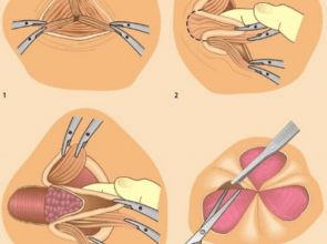 Кровотеча після операції на геморой: причини та методи лікування