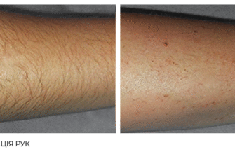 Лазерна епіляція: чи є небезпечні наслідки та ризики для здоров’я?