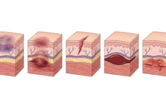 Лікування некрозу: методи, поради та можливості відновлення тканин