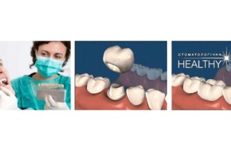 Металокераміка чи цирконій: як обрати оптимальний матеріал зубних коронок?