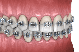 Правильний прикус: який він та як його забезпечити? Поради експертів