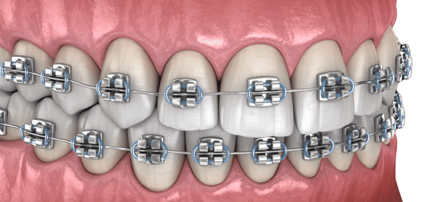 Правильний прикус: який він та як його забезпечити? Поради експертів Правильний прикус: який він та як його забезпечити? Поради експертів