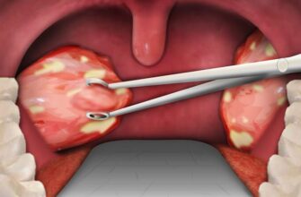 Причини та лікування білого нальоту після видалення гланд: поради лікарів