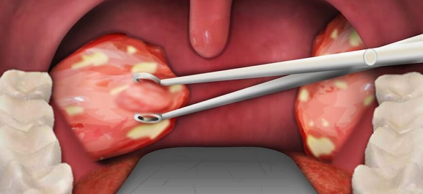 Причини та лікування білого нальоту після видалення гланд: поради лікарів