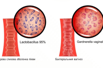Причини та виділення після вагінальних свічок: що варто знати?