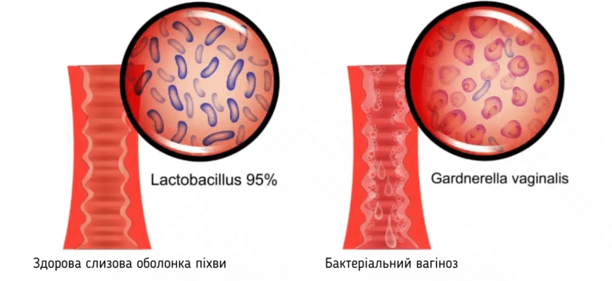 Причини та виділення після вагінальних свічок: що варто знати?