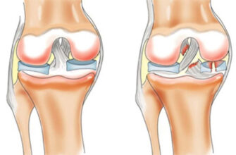 Реабілітація після пластики передньої хрестоподібної зв’язки: ключ до успіху