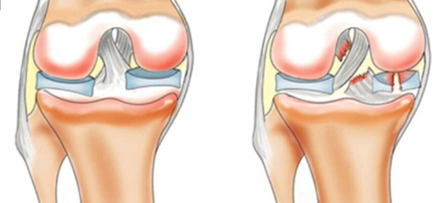 Реабілітація після пластики передньої хрестоподібної зв’язки: ключ до успіху