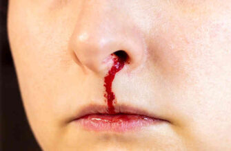 Що означає, коли сниться кров з носа: тлумачення і значення сну