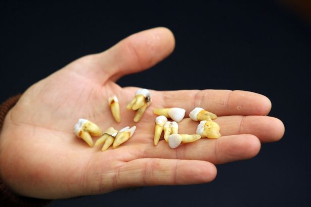 Сон: зуб, вирвати собі зуб без крові, значення та властивості сну ...