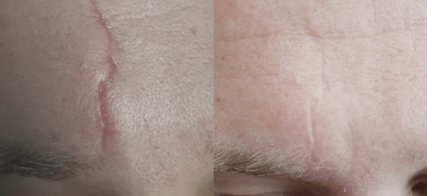 Шрам після видалення щитовидки: як доглядати і зменшити сліди