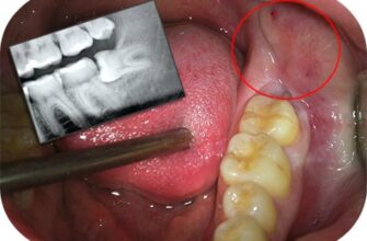 Скільки коренів може мати зуб мудрості: що варто знати про анатомію