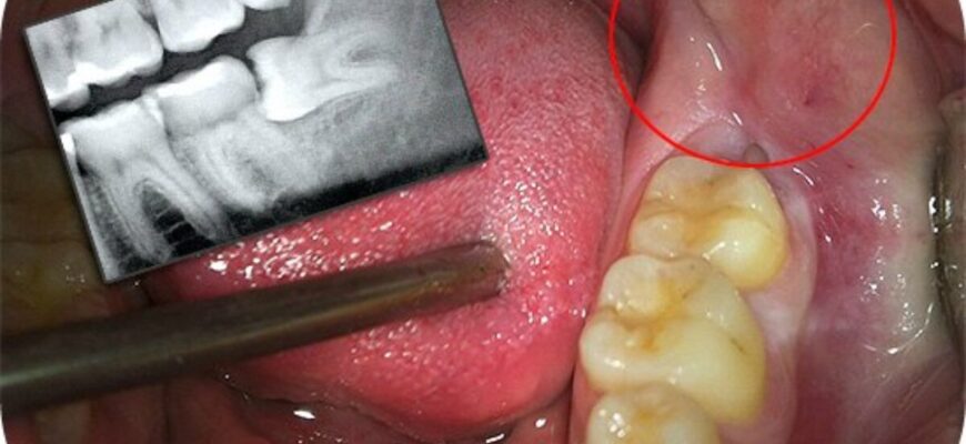 Скільки коренів може мати зуб мудрості: що варто знати про анатомію