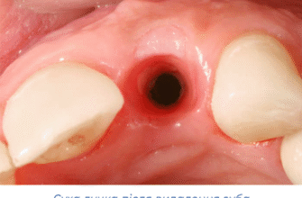 Тривалість кровотечі після видалення зуба: скільки часу триває процес?
