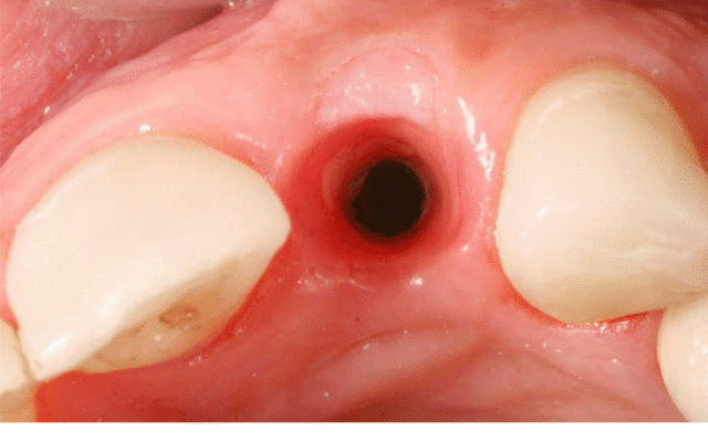 Тривалість кровотечі після видалення зуба: скільки часу триває процес?