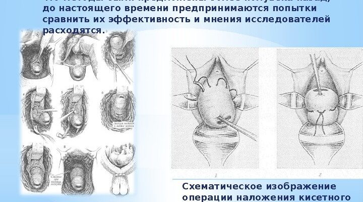 Вагітність: оптимальна довжина шийки матки для здорового перебігу