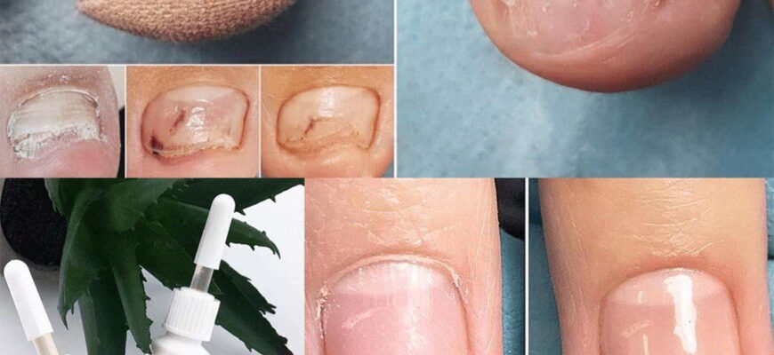 Відновлення і догляд за нігтями: що робити після гель-лаку?