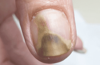 Відпали нігті на руках у сні: що це означає та як тлумачити