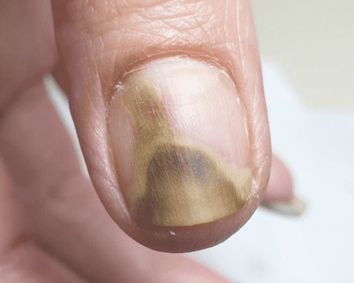 Відпали нігті на руках у сні: що це означає та як тлумачити