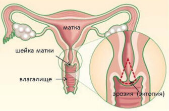 Виділення після припікання ерозії шийки матки: досвід та поради на форумі