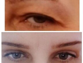 Вигляд очей після блефаропластики: все, що потрібно знати про результат