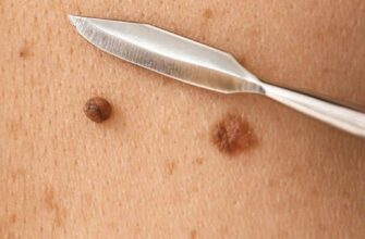 Як доглядати за раною після видалення родимки: поради і рекомендації