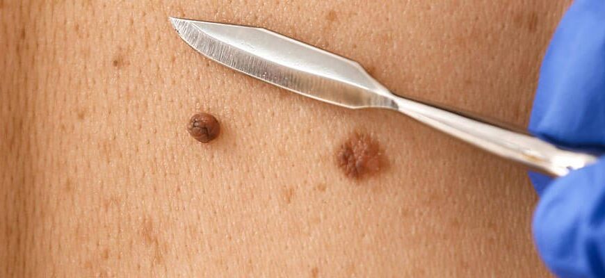 Як доглядати за раною після видалення родимки: поради і рекомендації