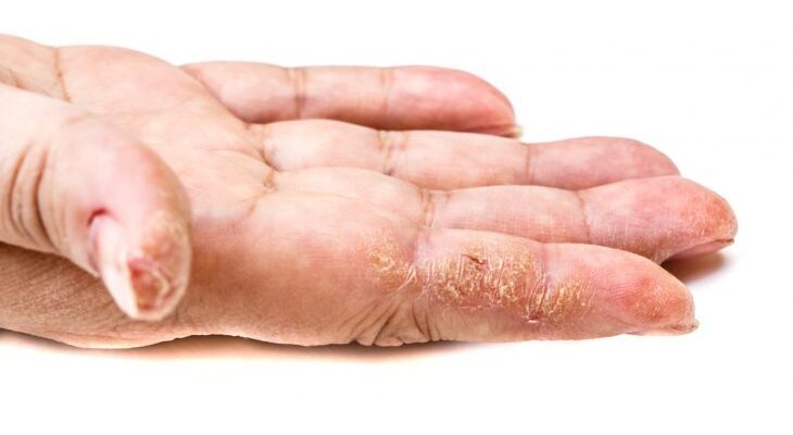 Якого вітаміну не вистачає, якщо лущиться шкіра на пальцях рук?